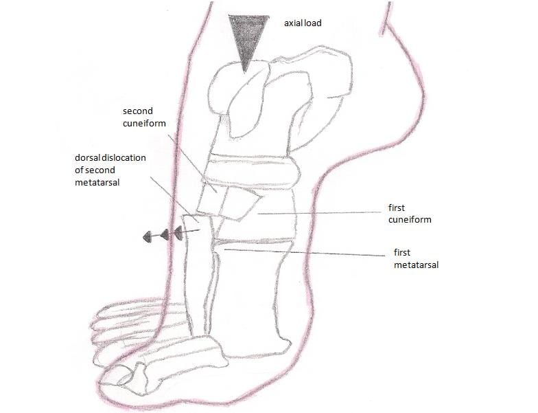 Lisfranc_injury