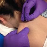 Functional Dry Needling