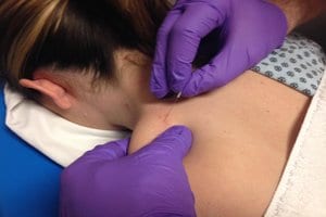physical therapist performs dry needling on patient